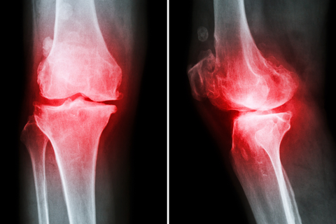 Osteoarthritis